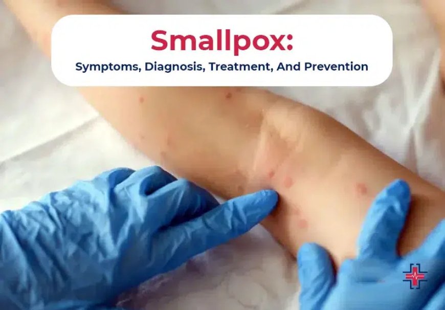 The 10 Critical Smallpox Symptoms You Should Never Ignore