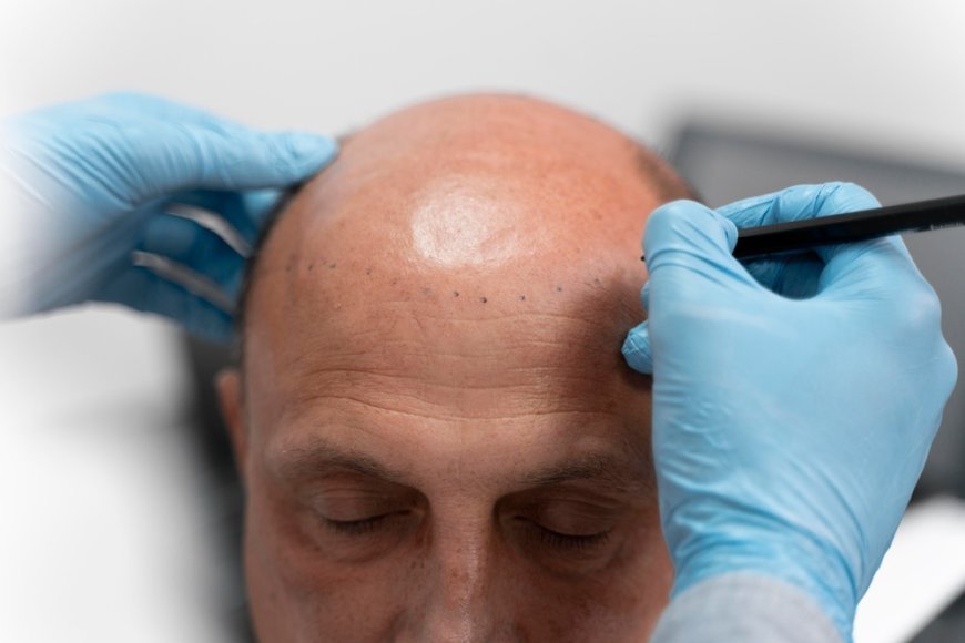 The Science Behind Hair Transplant: How Does it Really Work?