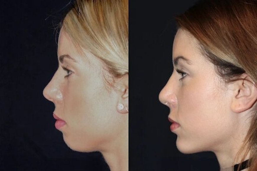 Top Reasons to Trust the Best Plastic Surgeons in dubai for Chin Fillers