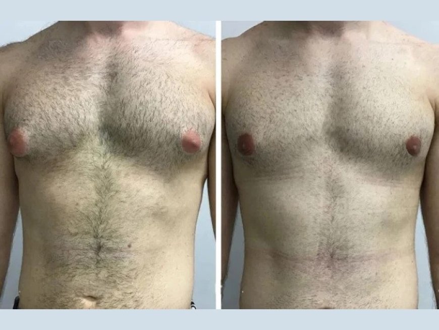 Best Gynecomastia Surgeon in Dubai: Meet the Top Experts in the Field