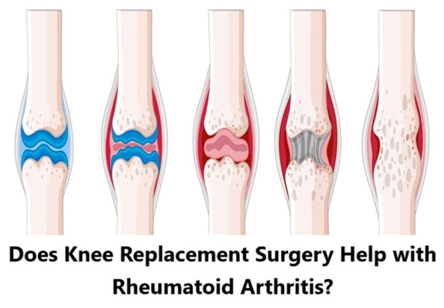 Does Knee Replacement Surgery Help with Rheumatoid Arthritis?