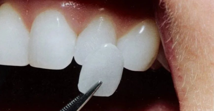 Cost of Dental Veneers: What to Expect During the Procedure