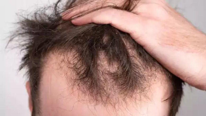 Saxenda and Hair Loss: What’s the Real Impact