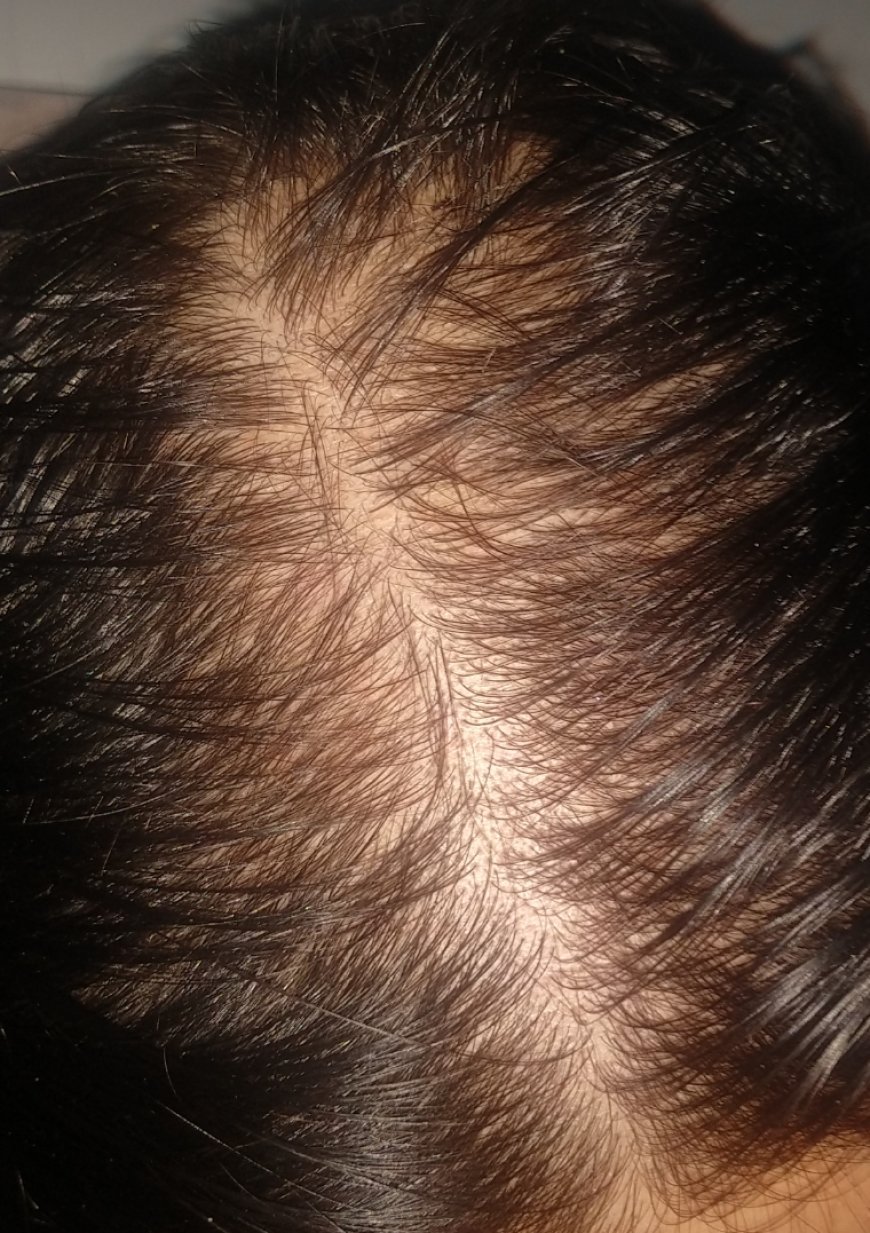 Can Saxenda Cause Hair Loss? A Closer Look