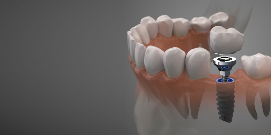 All-on-4 Dental Implants: A Game-Changer for Full Mouth Restoration