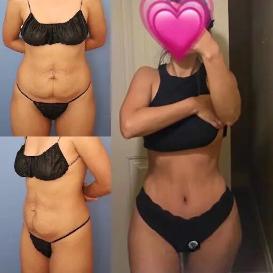 Why Best Doctors in Dubai Use Advanced Tummy Tuck Technology