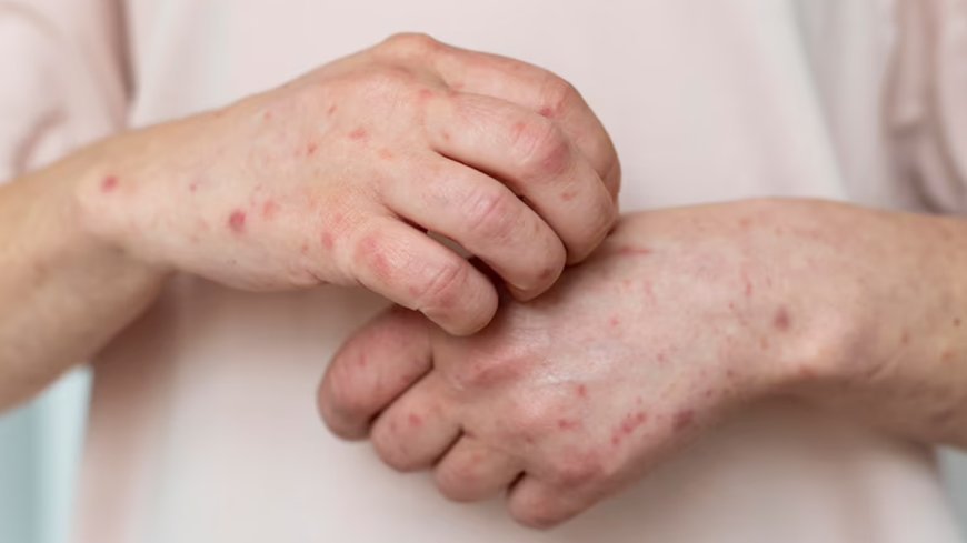 How Diet Impacts Acne, Psoriasis, and Other Skin Conditions