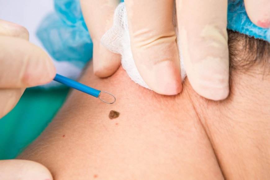 Salicylic Acid Help Remove Warts: Safe, Fast, and Easy