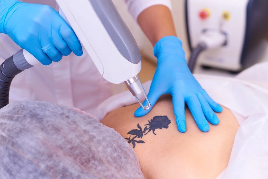 What Happens to Tattoo Ink Under Your Skin During Laser Removal?