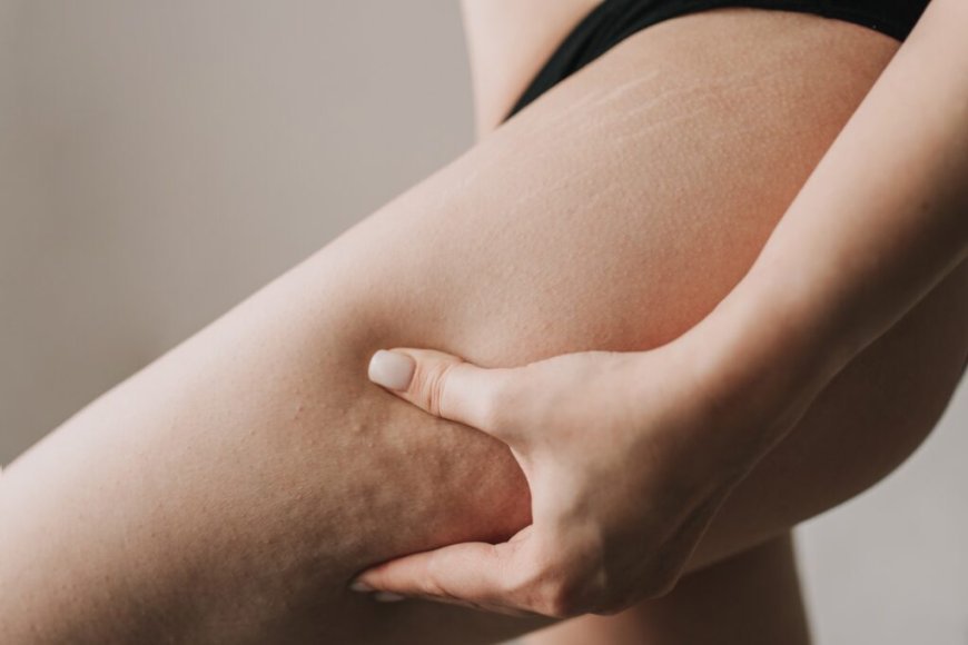 Cellulite Removal for Thighs: Effective Solutions
