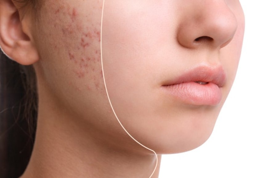 Best Skincare Brands for Effective Acne Treatment