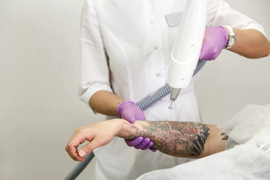 From Regret to Relief: My Tattoo Removal Journey