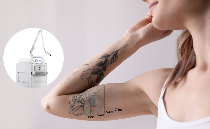 Laser Removal vs. Tattoo Cover-Ups: Which Is Right for You?