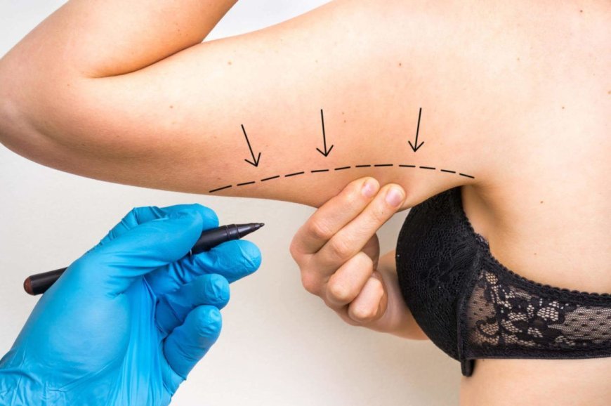 Brachioplasty: Trim Excess Skin and Feel Free