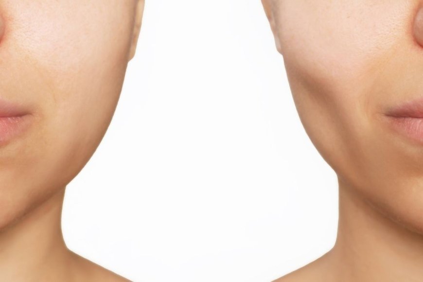 Buccal Fat Removal Aftercare: What to Know
