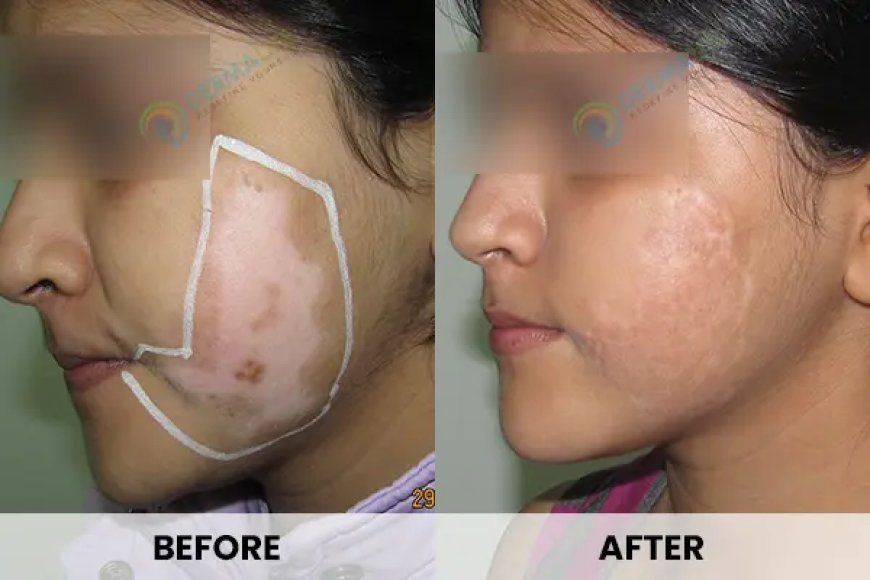 Understanding Vitiligo: Symptoms, Types & Treatment Options in Delhi