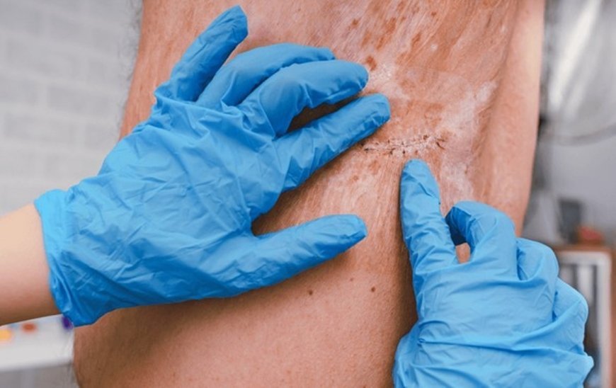 Reconstructive burn surgery: Boost your recovery