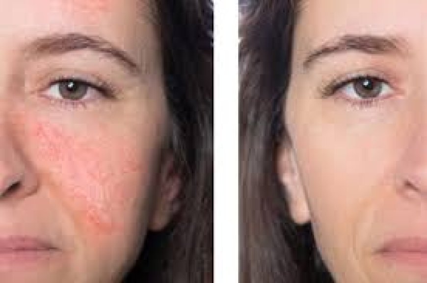 Why Treating Broken Capillaries Improves Skin Health