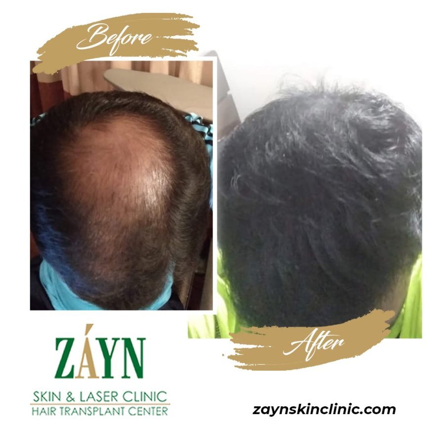 The Ultimate Guide to Choosing the Right Hair Transplant Clinic in Pune