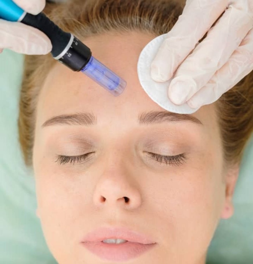 How often to do micro-needling for acne scars