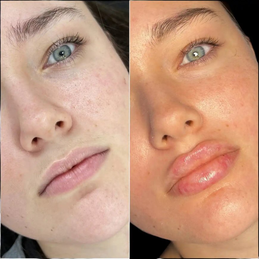 Achieve Flawless Skin with the Best Doctors in Dubai for Fillers