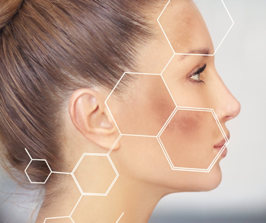 Melasma Treatment: Clear Skin in Every Season