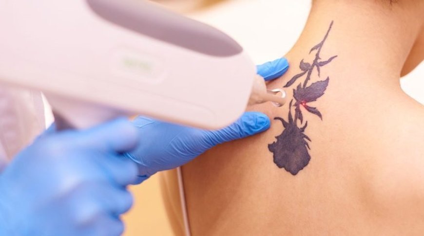 Laser Tattoo Removal: No More Tattoo Regret