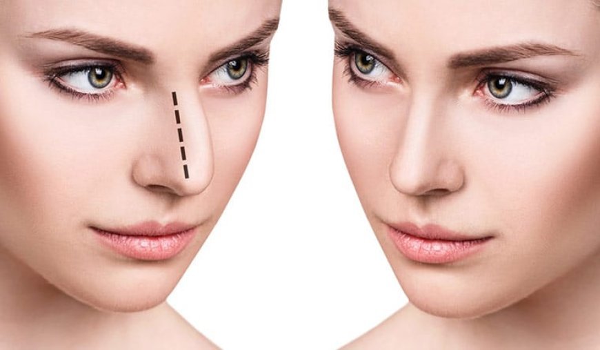 Non Surgical Rhinoplasty: Perfect for Minor Corrections