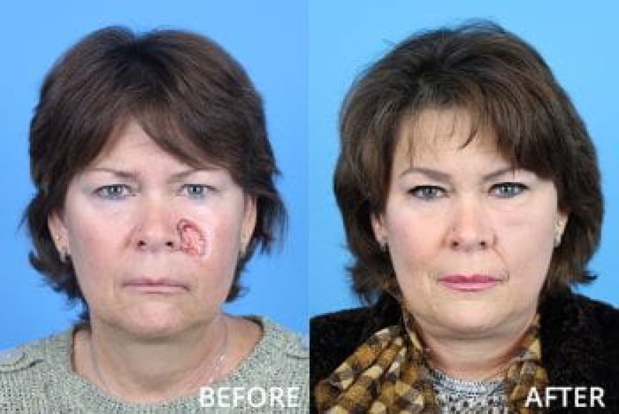 After Care Plastic Surgery Nurse: The Key to a Safe and Stress-Free Recovery