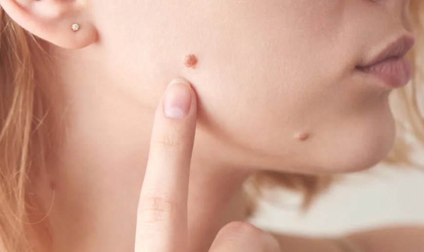 Best Time to Schedule Warts Removal Surgery