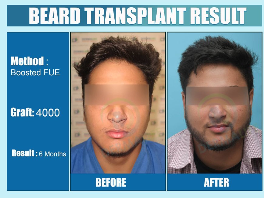 Understanding the Need for Beard Hair Transplant