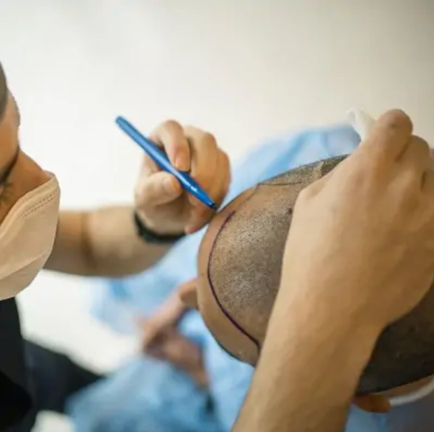 Hair Transplant Dubai – Why Medicure Is the Trusted Name for Hair Restoration