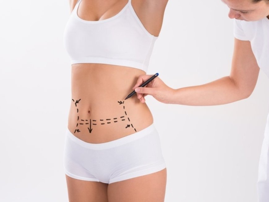 Weight Loss Success with Tummy Tuck in Islamabad