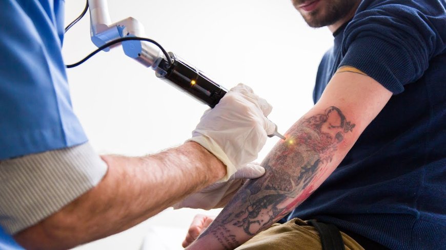 How many sessions are required to remove a tattoo completely?