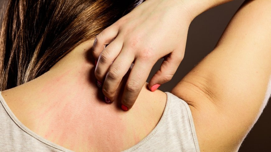 Can a dermatologist treat scalp eczema forever