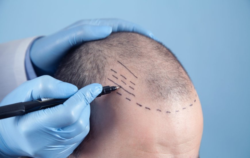 6-Month Crown Hair Transplant Progress Timeline