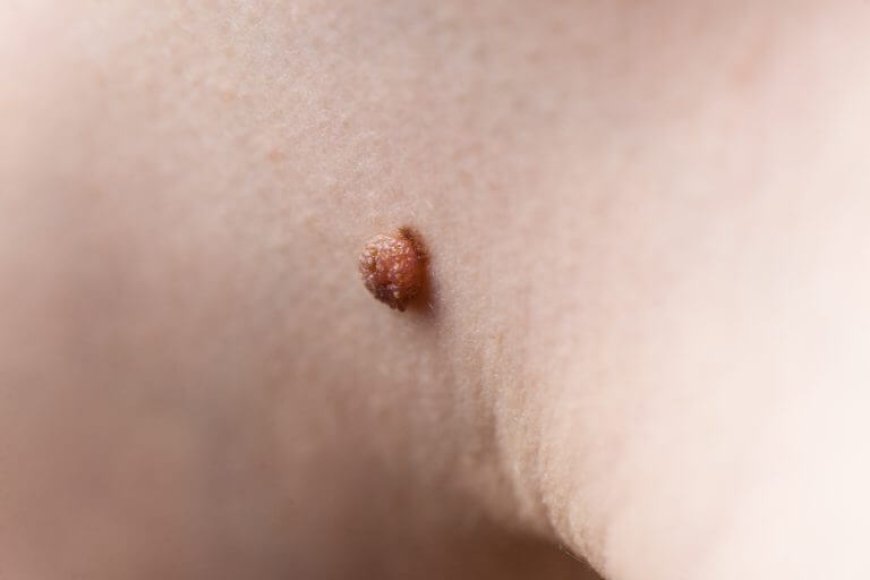 How to Remove Skin Tags on the Inner Thigh Safely With Minimal Pain