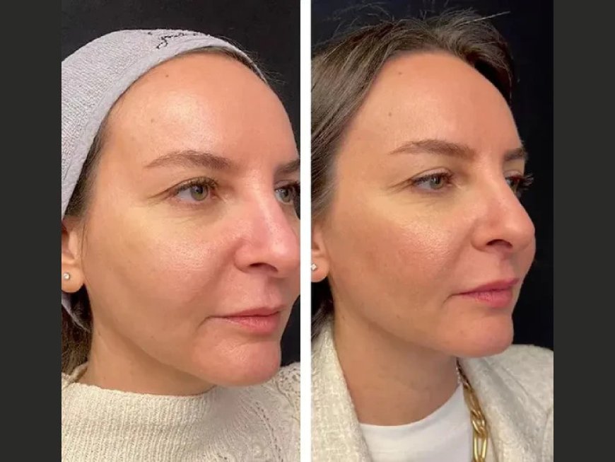 Mesotherapy in Dubai: A Game-Changer for Skin Brightening
