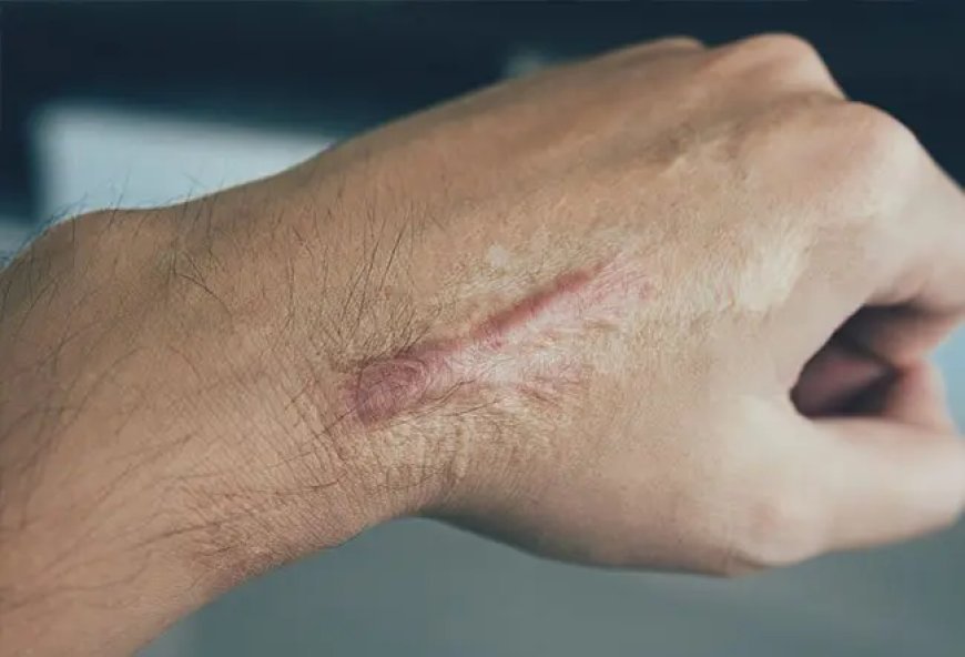 Restore Skin Beauty with Surgical Scar Revision Surgery