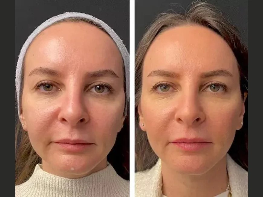 The Cost of Mesotherapy in Dubai: What the Best Plastic Surgeon in Dubai Wants You to Know