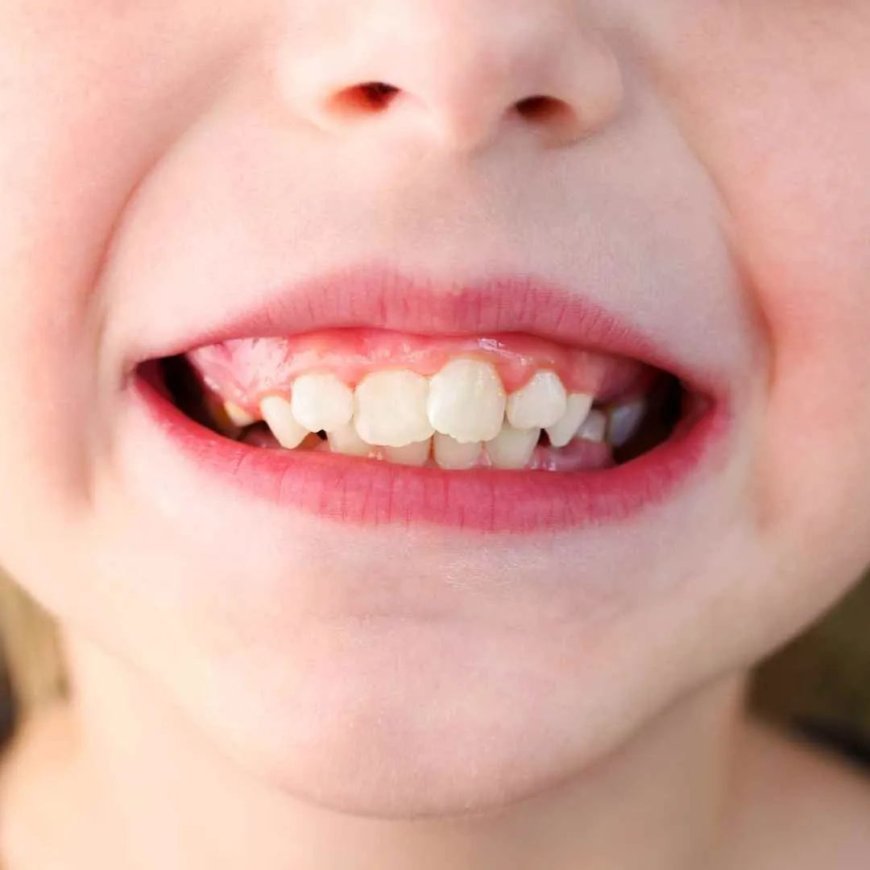 Can Buck Teeth Be Corrected Without Braces?
