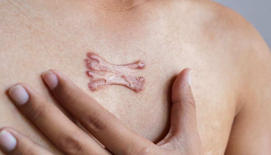 New Breakthroughs: The Future of Keloid Treatment in Islamabad