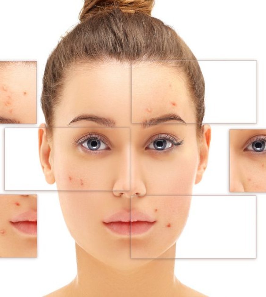 How Laser Acne Treatment Works: The Science Behind Clear Skin